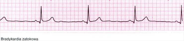EKG - bradykardia zatokowa.jpg